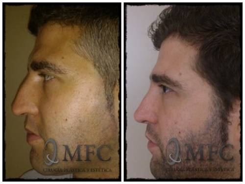 Rinoplastia